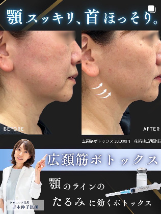 顎のラインのたるみに効く広頚筋ボトックス