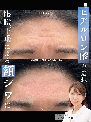 眼瞼下垂による額シワにヒアルロン酸を選択