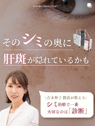 そのシミの奥に肝斑が隠れているかも
