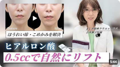 ヒアルロン酸0.5㏄で自然にリフト
